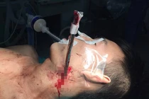 Cứu sống nam thanh niên bị thanh sắt nhọn bắn thẳng vào cổ