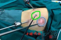 Bé gái 8 tuổi suýt mất mạng, bác sĩ phát hiện thứ khủng khiếp