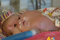 Quặn lòng em bé mới sinh có khối u “khủng” trong miệng