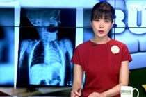Kinh hoàng phát hiện tụ điện trong phế quản bé 8 tháng tuổi 