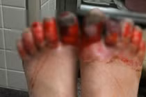 Cảnh báo có thể hoại tử chi, mất chân vì nhiễm lạnh