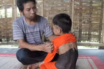 Xót xa bé gái 5 tuổi mọc lông như 'người rừng' ở Nghệ An