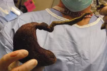 Những hội chứng hiếm gặp kỳ quặc nhất lịch sử loài người 