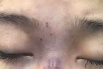 Chồng tiêm filler làm mù mắt vợ