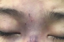 Chồng tiêm filler làm mù mắt vợ