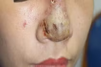 Kinh hoàng ổ mủ trong mũi sau khi tiêm filler tại spa ở Hà Nội