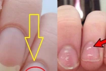 Đốm trắng trên móng tay tố căn bệnh nguy hiểm, nhiều người vẫn vô tư bỏ qua