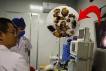 Ăn 1 loại quả khi đói, người phụ nữ bị sỏi to như trứng ngỗng