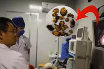 Ăn 1 loại quả khi đói, người phụ nữ bị sỏi to như trứng ngỗng