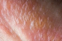 Mụn nước là gì? Nguyên nhân xuất hiện và cách điều trị