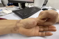 Giun bò lổm ngổm dưới da người phụ nữ nuôi 3 con chó, 5 con mèo