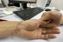 Giun bò lổm ngổm dưới da người phụ nữ nuôi 3 con chó, 5 con mèo