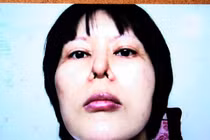 Những chiếc mũi biến dạng kinh hoàng sau thẩm mỹ