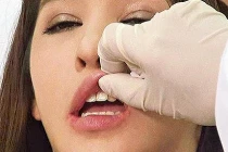 Cận cảnh kỹ thuật bơm môi, cấy mỡ làm đẹp