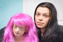 Bé 11 tuổi trông như bà cụ 80 vì mắc bệnh lạ