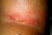 Kinh hoàng nâng ngực giá rẻ bị hoại tử