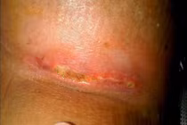 Kinh hoàng nâng ngực giá rẻ bị hoại tử