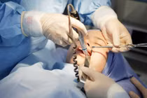 Nguy hại khôn lường khi gọt cằm V-line