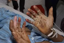 Điểm mặt những bệnh chết người từ món ăn tái sống