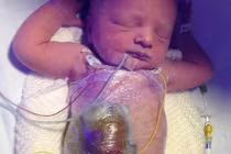 Xót lòng những bé sơ sinh có nội tạng ngoài cơ thể