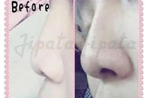 Serum nâng sống mũi: Coi chừng tiền mất tật mang