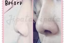 Serum nâng sống mũi: Coi chừng tiền mất tật mang