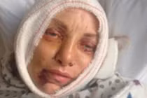 Khuôn mặt biến dạng khủng khiếp do phẫu thuật thẩm mỹ