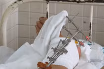 Quy trình nối chân tay bị đứt rời 