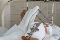 Quy trình nối chân tay bị đứt rời 