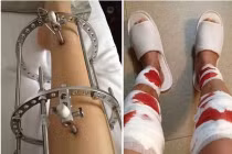 Điểm mặt những công nghệ đẽo gọt chân làm đẹp đau đớn