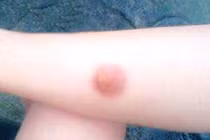 Những điều cần làm ngay khi bị bỏng bô xe máy