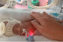 Bé 0,5kg sinh trong cơn co giật sống sót kỳ diệu