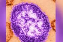 Sắp có thuốc uống chữa khỏi bệnh sởi