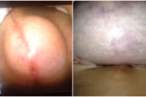 Gái trẻ bị nổ ngực silicone khi đang ngủ