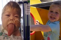 Thương tâm bé gái có chiếc lưỡi khủng quá cỡ