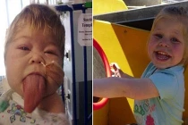 Thương tâm bé gái có chiếc lưỡi khủng quá cỡ