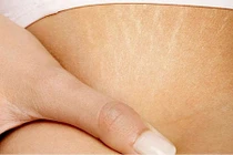 Những quan điểm sai lầm về rạn da