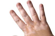 Tận mắt bệnh da liễu "cày nát" nhan sắc