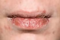 Mẹo cứu nguy đôi môi nứt nẻ chảy máu mùa đông