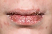 Mẹo cứu nguy đôi môi nứt nẻ chảy máu mùa đông