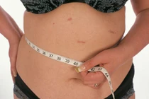 1001 biến chứng sau phẫu thuật cắt dạ dày giảm cân