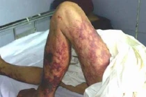 Cận cảnh liên cầu khuẩn lợn xâm nhập "giết người" 