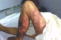 Cận cảnh liên cầu khuẩn lợn xâm nhập "giết người" 