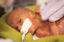 Ảnh xúc động về những em bé sinh non