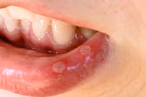 Mẹo hay chữa nhiệt miệng khi bị nóng trong