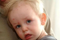 Sai lầm chết người khi chăm sóc trẻ bị thủy đậu