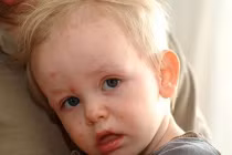 Sai lầm chết người khi chăm sóc trẻ bị thủy đậu