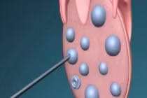 Cận cảnh quy trình chọc hút trứng trong thụ tinh ống nghiệm