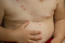 Cách đơn giản nhận biết bé bị thủy đậu
