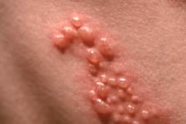 Hình ảnh bệnh tình dục phá nát cơ thể